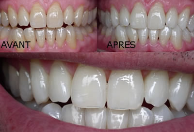 Exemple de résultat de blanchiment des dents par Laser